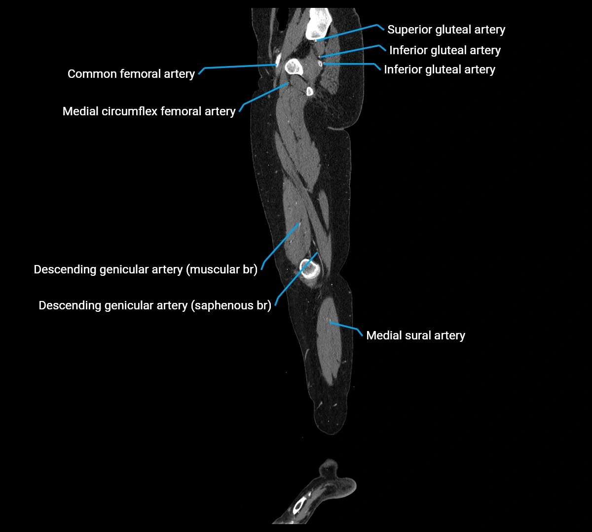CTA lower limb sagittal cross sectional anatomy labelled image _24 (2).webp